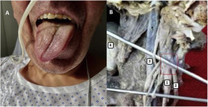 A) Desviación de hemilengua derecha por parálisis ipsilateral del par XII. B) 1: nervio vago; 2: nervio hipogloso; 3: arteria carótida interna; 4: paladar blando. Recuadro: punto de proximidad anatómica entre nervio vago e hipogloso.
