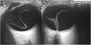 En el globo ocular izquierdo se visualiza una imagen lineal de morfología en V fija al disco óptico, sugestiva de desprendimiento completo de retina. En localización interna a la retina se visualizan otras imágenes lineales móviles igualmente fijas al disco óptico sugestivas de membranas residuales de la endoftalmitis.