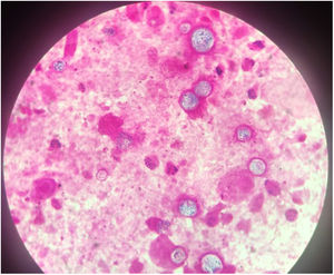 Gram and Calcofluor stain showing spherules and endospores inside them.