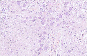 Lung parenchyma under hematoxylin/eosine stain. Spherules are seen inside the pulmonary tissue.