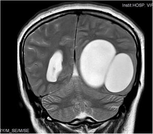 TC craneal simple. Estructura quística de localización temporo-occipital izquierda.