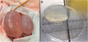 A) Disección de quistes hidatídicos mediante técnica de Dowling (obsérvese el catéter en la parte superior de la imagen, el cual está ubicado en el plano profundo entre el quiste medial y el cerebro) B) Aspecto macroscópico del quiste hidatídico cerebral de mayor tamaño. Medidas: 8,5cm de longitud y 110ml de volumen.
