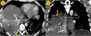 Cortes axial (A) y coronal (B) de una angio-TC de arterias pulmonares con contraste yodado intravenoso. Se aprecia una extensa consolidación pulmonar en LID, que presenta captación heterogénea de contraste. Predomina un componente más hipodenso con escaso realce (flecha amarilla, número 1), identificándose otras zonas normocaptantes de mayor densidad (flecha blanca, número 2). Mínima cantidad de derrame pleural derecho (flecha azul, número 3). Los hallazgos son compatibles con neumonía necrosante asociada a mínimo derrame pleural.