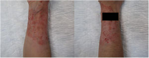 Imagen de la cara anterior y posterior del antebrazo.