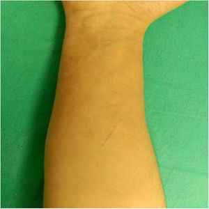 Imagen de la cara anterior del brazo a los 2 meses de tratamiento.