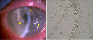 A) Tres lesiones adelgazadas con halo endotelial sublesional de aspecto cristalino (flechas amarillas). Se tomaron muestras de las mismas y se enviaron al laboratorio de microbiología para cultivo y a anatomía patológica para estudio. Esas lesiones se colonizaron por S. oralis. B) Crecimiento típico de los quistes de Acanthamoeba spp. en medio de Page cubierto con Escherichia coli. Presencia de láminas contiguas de quistes. Sin tinción y con aumento ×100.