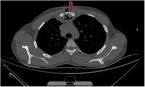 Computed tomography showing bone destruction (arrow) and retosternal air.