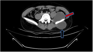 Abdominal scan demonstrating a psoas abscess (red arrow) and a gluteal abscess (black arrow).
