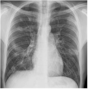 Radiografía de tórax de ingreso. Se observan múltiples infiltrados nodulares.