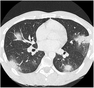 TC de tórax que muestra condensaciones pulmonares nodulares bilaterales.