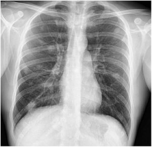 Radiografía de tórax. Patrón de infiltración pulmonar diferente a imágenes previas.