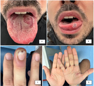 Monkeypox skin manifestations: two superficial ulcers located to the dorsum (A) and border of the tongue (B); acute paronychia and subungual ulcers of left middle finger (C); umbilicated whitish papule on left palm (D).