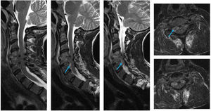 Resonancia magnética cervical: cortes coronales y transversales. Se objetiva espondilodiscitis C4-C5 y absceso epidural entre C4 y C6 (flecha).