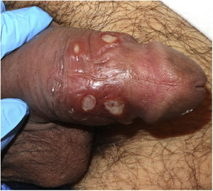 Chancros sifilíticos múltiples. Ocho úlceras superficiales con fondo de fibrina y bordes sobreelevados.