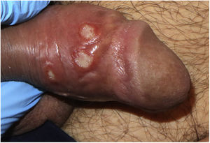 Chancros sifilíticos múltiples. Ocho úlceras superficiales con fondo de fibrina y bordes sobreelevados.