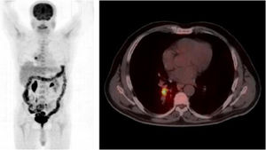 PET basal en el que se observa imagen hipercaptante en bronquio segmentario de lóbulo inferior derecho (tumor primario) y adenopatía subcarinal con menor captación. La captación a nivel de colon es frecuente en pacientes que reciben tratamiento con metformina.