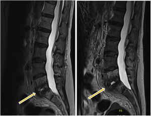 RMN de la vértebra lumbosacra.