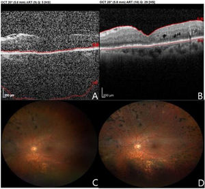 Tomografía de coherencia óptica (OCT) realizada al diagnóstico de endoftalmitis. A) Imagen de condensación vítrea. B) Imagen de una OCT realizada 2 semanas después de la vitrectomía y tras mantenimiento del tratamiento antibiótico. Algo turbio (C) y más claro (D), se observan 2 imágenes de retinografías realizadas una y 2 semanas después de la vitrectomía respectivamente, en las que se observa una progresiva mejoría con aclaramiento de los medios coincidiendo con la mejoría de la agudeza visual de la paciente.