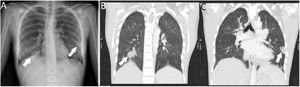 Radiografía de tórax (A): condensaciones pulmonares con tendencia a la cavitación. Reconstrucción coronal de la TC (B y C) con ventana de pulmón que permite definir mejor las lesiones, con cavitación en lóbulo inferior izquierdo.