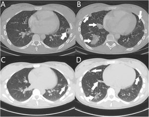 Imágenes axiales de TC torácica: buena evolución radiológica con involución de las condensaciones pulmonares al ingreso (A y B) comparadas tras tratamiento antibiótico (C y D).