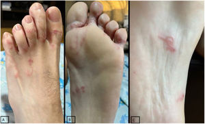 Lesiones eritematosas serpiginosas en ambos pies (A, B, C).