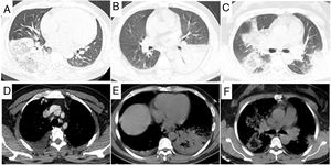 A set of representative CT images of psittacosis pneumonia. (A) Lobar infiltration, (B, E) consolidation, (C, F) reserved halo, and (D) pleural effusion were observed in our patients.
