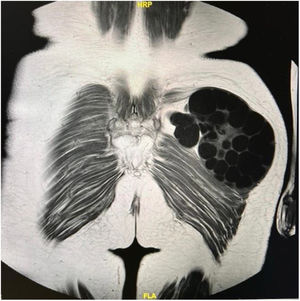 TC toracoabdominopélvico. Lesión multilocular en glúteo.