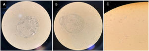 Visión microscópica (40x) de protoescólices A y B) y ganchos libres C) en líquido intravesicular (imagen aumentada).