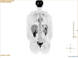 Focos hipermetabólicos en ambos campos pulmonares y en las adenopatías perihiliares.