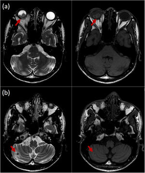 A) Resonancia magnética orbitaria en T2 y T1, que evidenció lesiones retinianas con realce liso de sus paredes, que ocupaban los cuadrantes inferiores del globo ocular. B) Lesión de 8mm en el hemisferio cerebeloso derecho, hipointensa en T2, con relace en anillo y ligeramente hiperintensa en T1.