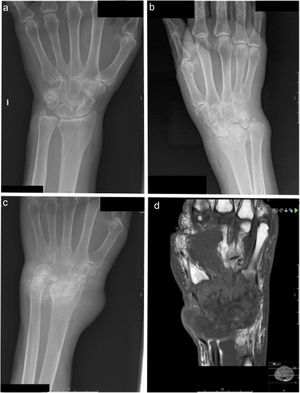 A. Radiografía normal. B. Radiografía ósea en la que se aprecia poliartropatía en el carpo y radiocarpal; articulación con calcificaciones sinoviales. C. Radiografía ósea de control a los 8 meses de la imagen B; se aprecia progresión del daño articular, con afectación ósea que sugiere osteomielitis. D. Resonancia magnética. En T1 con contraste se aprecia daño difuso severo en todos los huesos del carpo, cúbito y radio distales, segundo a quinto metacarpo, así como adelgazamiento sinovial en todas las articulaciones del carpo con una colección líquida heterogénea en el dorso de la muñeca.