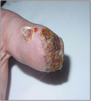 Hyperkeratotic papules measuring 25mm×13mm on his left thumb.