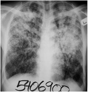 Chest radiography showing bilateral heterogeneous infiltrations on superior and middle zones.