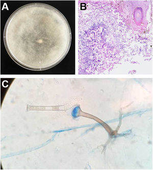 (A) Anverso de una placa de agar patata en el que se observa el crecimiento del mucoral a las 72 horas de incubación. (B) Corte histológico teñido con Periodic Acid-Schiff de la biopsia de piel en el que se observan hifas y angioinvasión de la vasculatura cercana. (C) Esporangióforos y rizoides característicos de Saksenaea spp. (tinción con azul lactofenol).