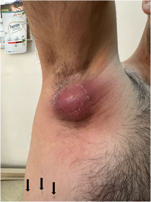Tender, erythematous and fluctuant lymphadenopathy and marks of cat-flea bites (arrows).