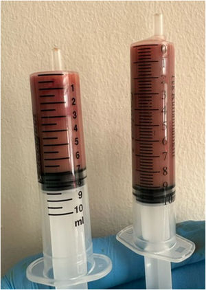 Macroscopic appearance of the abscess fluid.