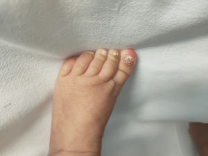 Hiperqueratosis con coloración amarillenta subungueal.