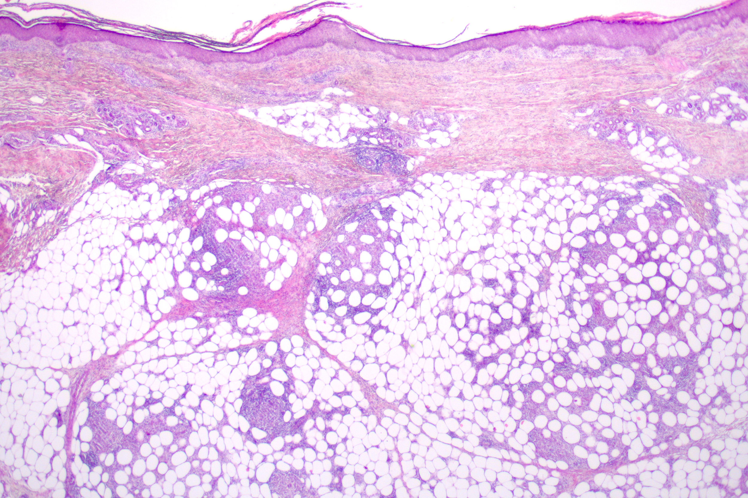 erythema induratum pathology outlines