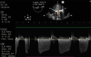 Ecocardiograma transesofágico centrado sobre la válvula mitral.