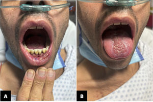 Clinical improvement in the lips was observed after 3 weeks of antiviral therapy.