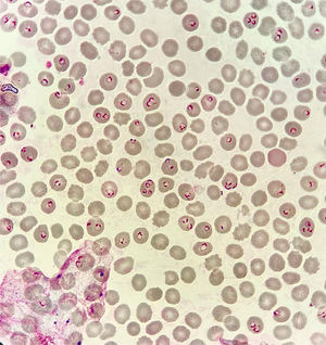Ring-form P. falciparum trophozoites in thin blood smear. Giemsa stain. 1000× resolution. Parasitemia >50%.