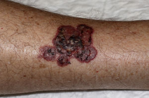 Violaceous crusted plaque on the posterolateral aspect of the patient