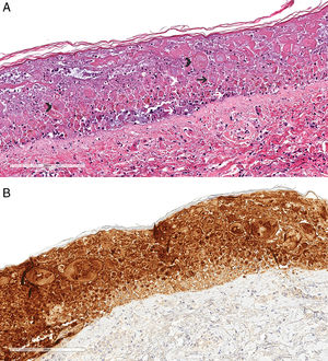 Histopathologic study revealed a widely necrotic epidermis with multinucleated acantholytic keratinocytes (black arrowhead), steel-gray nuclei (black arrow), nuclear molding (white arrowhead), and nuclear dust (white arrow) (hematoxylin and eosin, 20×) (A). Immunohistochemical study showed positive staining for type 1 Herpes simplex virus (20×) (B).