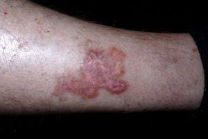 Remaining scar on the posterolateral aspect of the patient