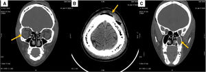 A) Colección intraorbitaria. B) Absceso subgaleal. C) Ocupación del seno maxilar izquierdo.