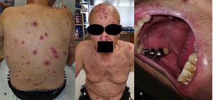 A) Pápulas con centro necrótico y costroso con halo eritematoso en polo cefálico y espalda. B) Pápulas con centro necrótico y costroso con halo eritematoso en región facial. C) Vesículas arracimadas en paladar duro junto con enantema.