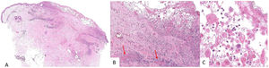 A) (HE, 2×): a pequeño aumento se observa un punch de piel con lesión epidérmica con formación de ampolla, así como componente inflamatorio perivascular superficial. B) (HE, 10×): a mayor aumento se identifican signos de vasculitis, con depósito de fibrina en las paredes vasculares (flechas rojas). C) (HE, 20×): detalle de la lesión epidérmica donde destacan elementos de gran tamaño multinucleados y con inclusiones intranucleares. HE: tinción de hematoxilina-eosina.