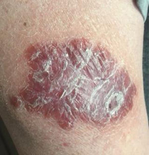 Skin lesion showing a brownish, indurated plaque measuring 6cm×10cm in size.