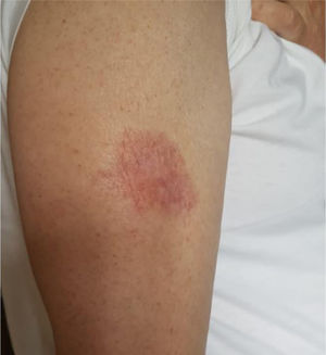 Significant improvement of the lesion in the third month of treatment.