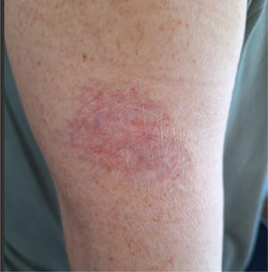 Final appearance of the lesion in the fifth year of treatment.